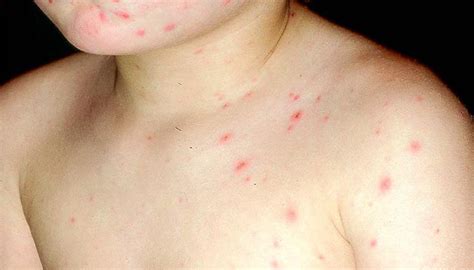 Allergiska utslag barn bilder