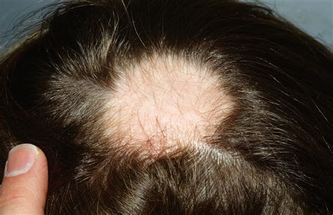 Alopecia Areata Ff