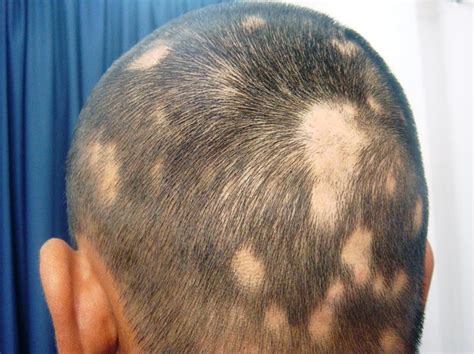 Alopecia areata