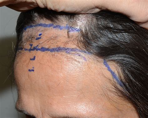Alopecia fibrosing frontal translate docx