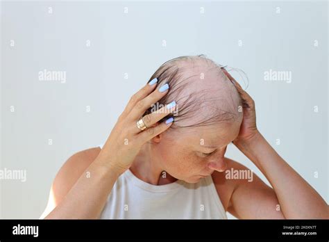 Alopezie-Perücken: Wiederherstellung von Vertrauen und Schönheit