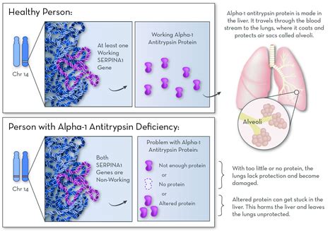 Alpha 1 Antitrypsin Deficiency and COPD The Connection