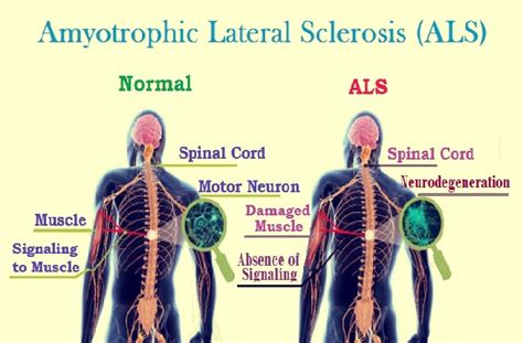 Als Amyotrophic Lateral Sclerosis