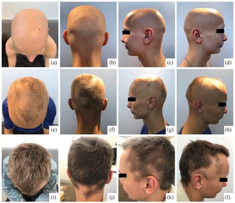 Alteration in Hair Texture Following Regrowth in Alopecia Areata