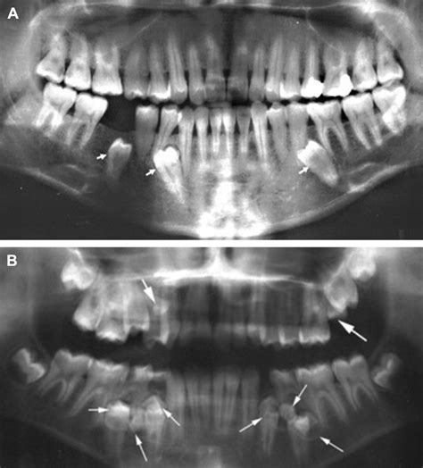 Alterations in Tooth Structure and Associated Systemic Conditions