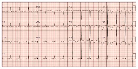 Altmetric – Intracranial Hemorrhage and Deep T-Wave Inversions