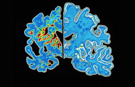 Alzheimer’s disease beyond amyloid: strategies for future …