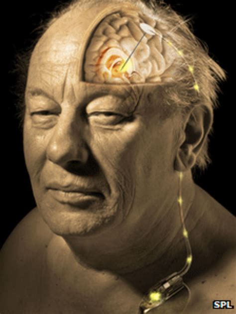 Alzheimer s Deep Brain Stimulation Reverses Disease
