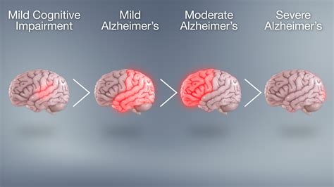 Alzheimer s disease