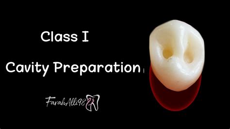 Amalgam Cavity Preparation Class 1