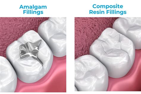 Amalgams Vs Composites: Which is The Better Choice?