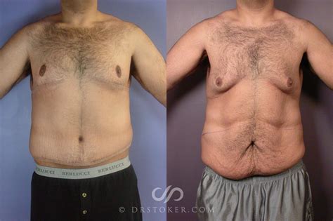 Amazing Transformation Tummy Tuck Before and After by Dr. Dev Wali ...