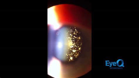 Amazing gold floaters in the eye! (Asteroid Hyalosis)