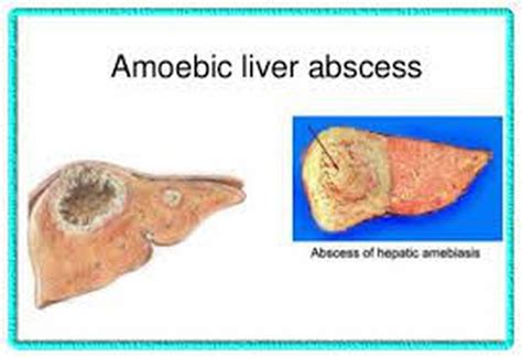 Amoebic Liver Abcess 04