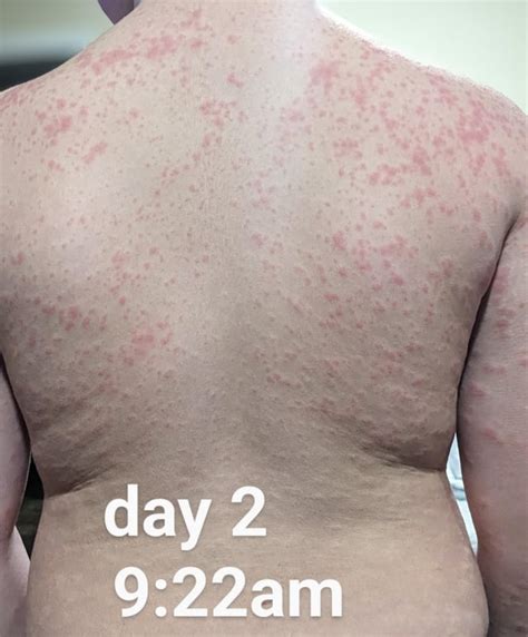 Amoxicillin allergi alternativ