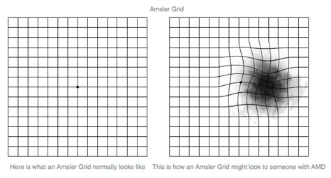 Amsler Grid Test for Retinal Conditions When to See a Doctor