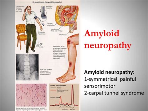 Amyloid Neuropathy