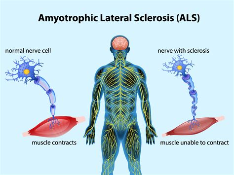 Amyotrophic Lateral Sclerosis (ALS) Tissue Donation Program