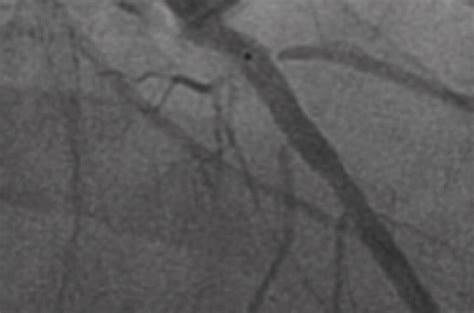 Anévrismes Intracrâniens Géants: Diagnostic et prise en charge