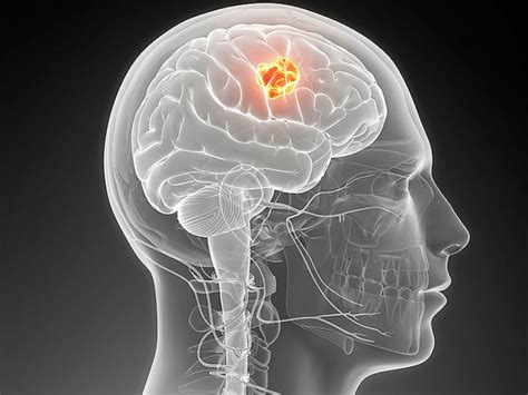 An ‘exciting’ glioblastoma study: Boston researchers create virus that can effectively target the aggressive brain cancer