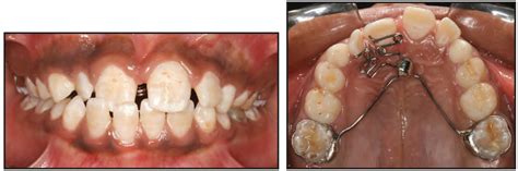 An Appliance for Treatment of Anterior Crossbite in Epilatic Patients