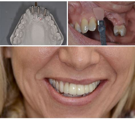 An Approach to Define Clinical Significance in Prosthodontics