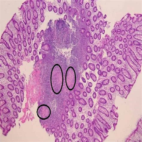 An Atypical Presentation of Crohn