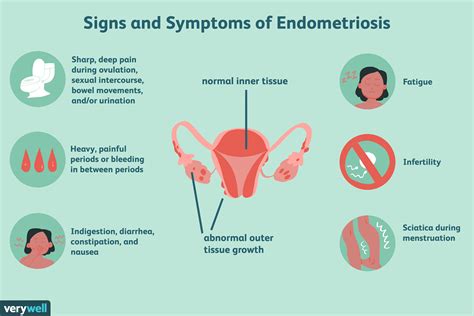An Effective and Natural Endometriosis Infertility Treatment