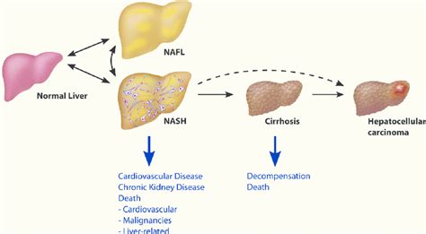 An Endocrine Perspective of Nonalcoholic Fatty Liver Disease