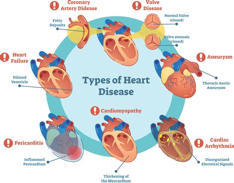 An Enlarged Heart is Indicative of Cardiac Disease