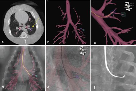 An Introduction to Cone Beam CT in Bronchoscopic …