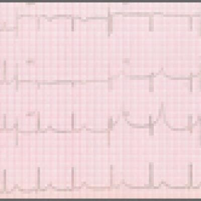 An Unusual Cause of Syncope With T-Wave Abnormalities - MDedge