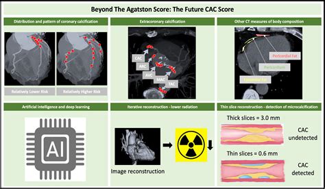 An Update on Coronary Artery Calcium Interpretation …