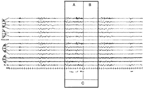 An example of Cyclic Alternating Pattern in sleep stage 2. The boxes
