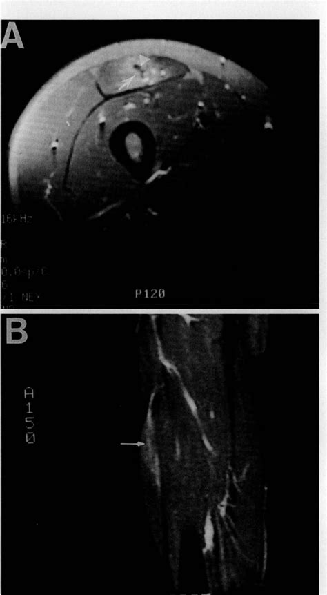 An explanation for various rectus femoris strain injuries using ...