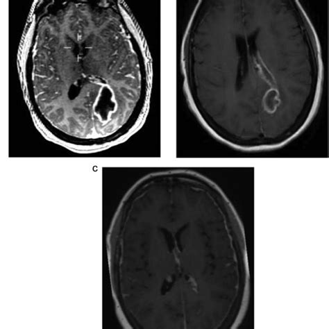 An intra cerebral abscess in a patient with Eisenm