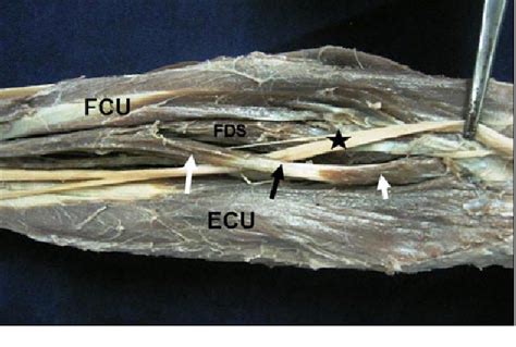 An unusual flexor of the little finger and ulnar nerve entrapment: A ...