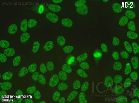 Ana pattern.  The metaphase plate depicts strong speckled pattern with some coarse ...
