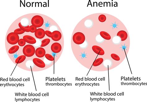 Anaimya. WHO. Anaemia is a condition in which there is a reduced number of red blood cells or the haemoglobin concentration within the red blood cells is lower than normal. … 