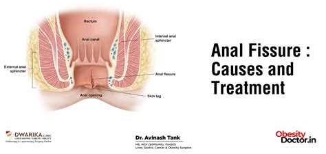 Anal Fissure