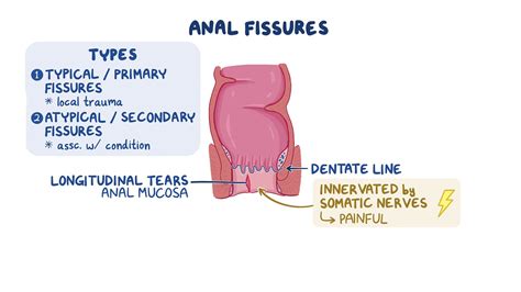 Anal Fissures