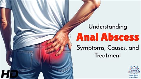 Anal abscess What it is causes symptoms and more