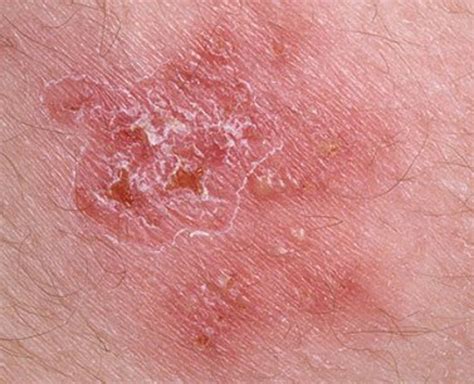 1. Anal herpes blisters, are red bumps or white that cover the ulcers that have ruptured or bled. The anal sores are painful, with tingling, and burning feels erupting from the anus. The blisters on the anus are fluid-filled. 1 2 3 4 2. Pain and itching around the anus ulcers that develop at the site of original 3.. 