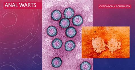 Anal warts solution picture. .  <a href=http://www.sasadoctor.com/wp-content/upload...