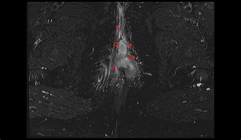 Analbalon im anal.  R&eacute;servez maintenant, payez plus tard sur Expedia.  3 days ago · FFI...