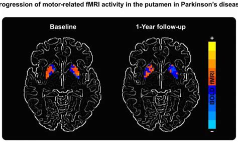 Analysis of Brain Activity Changes in Patients with Parkinson’s Disease …