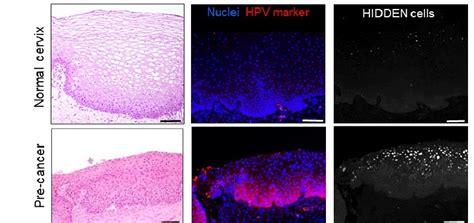 Analysis of HPV-Positive Cells Reveals New Population Found in Cancer