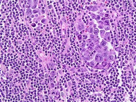 Anaplastic large cell lymphoma. Anaplastic large-cell lymphoma (ALCL) is a rare type of blood cancer. It's more common in young people, mostly boys. It doesn't run in families. ALCL is a serious illness. It can be fast growing,... 