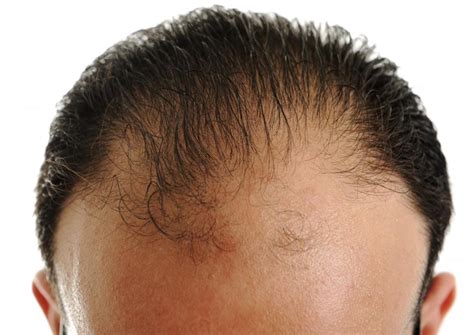 Hair loss from Anavar use is primarily due to the drug's androgenic properties. Androgens are hormones that play a role in male traits and reproductive activity. They are also crucial for hair growth in both men and women. However, when these hormones are imbalanced due to substances like Anavar, it can lead to hair thinning or loss.. 