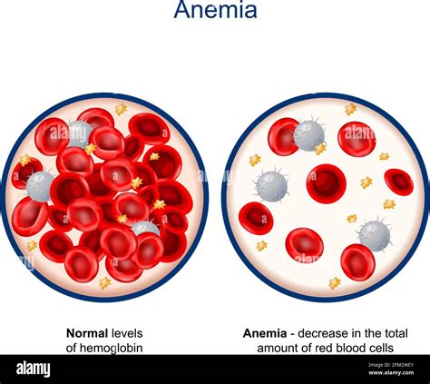 Anemia Associated with Hemoglobin S-A…